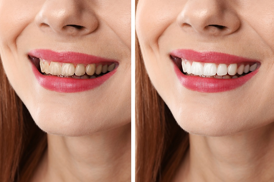 Zoom Whitening Zoom Whitening