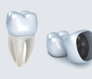 Dental Crowns